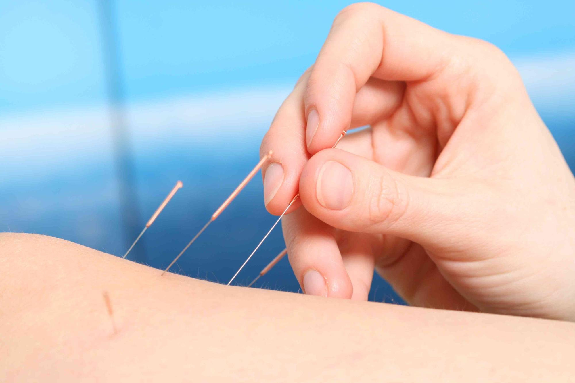 Quelle formation pour pratiquer l’acupuncture ?